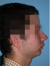 implantes dentales